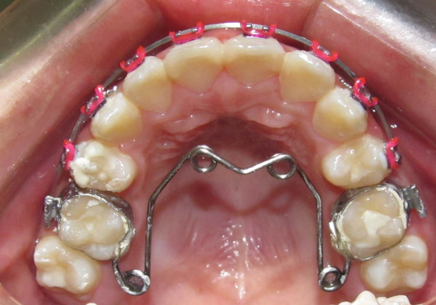 quad helix INSTITUTO RAMPAL